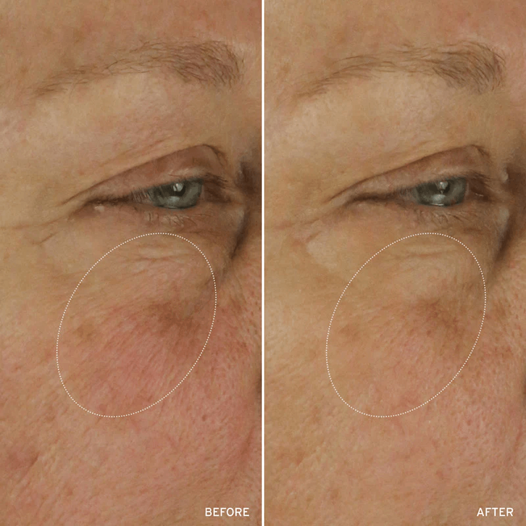 Cell Energizing Treatment before and after comparison highlighting improvement in skin texture and tone