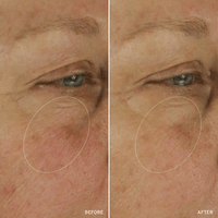 Cell Energizing Treatment before and after comparison highlighting improvement in skin texture and tone