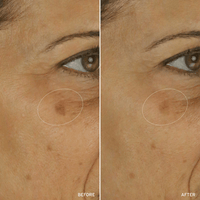 Cell Energizing Treatment before and after comparison highlighting reduction in dark spots
