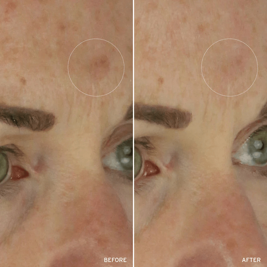 Cell Energizing Treatment before and after comparison highlighting improvement in skin texture and evenness of skin tone