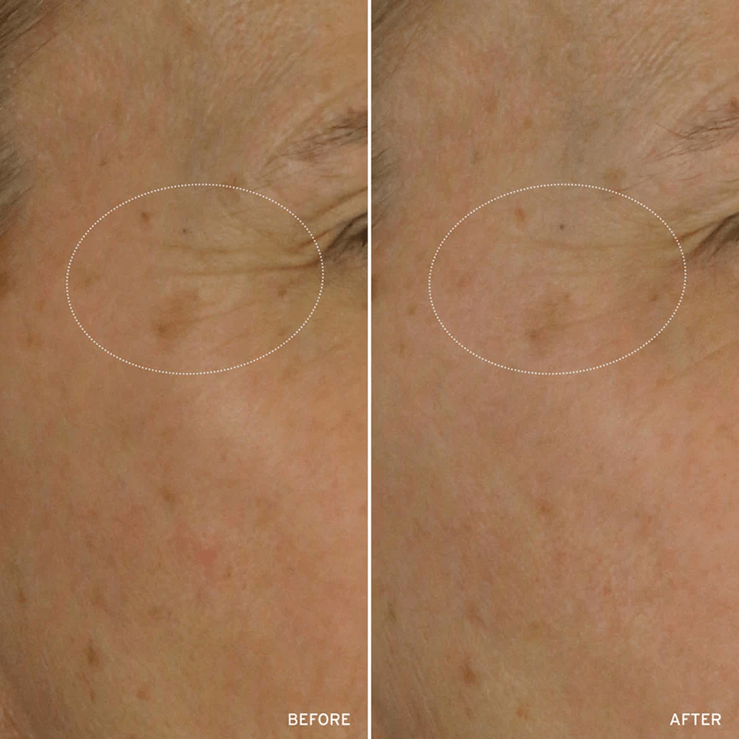 Cell Energizing Treatment before and after comparison highlighting reduction of fine lines and wrinkles on a woman's face near hey eyes