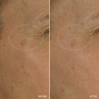 Cell Energizing Treatment before and after comparison highlighting reduction of fine lines and wrinkles on a woman's face near hey eyes