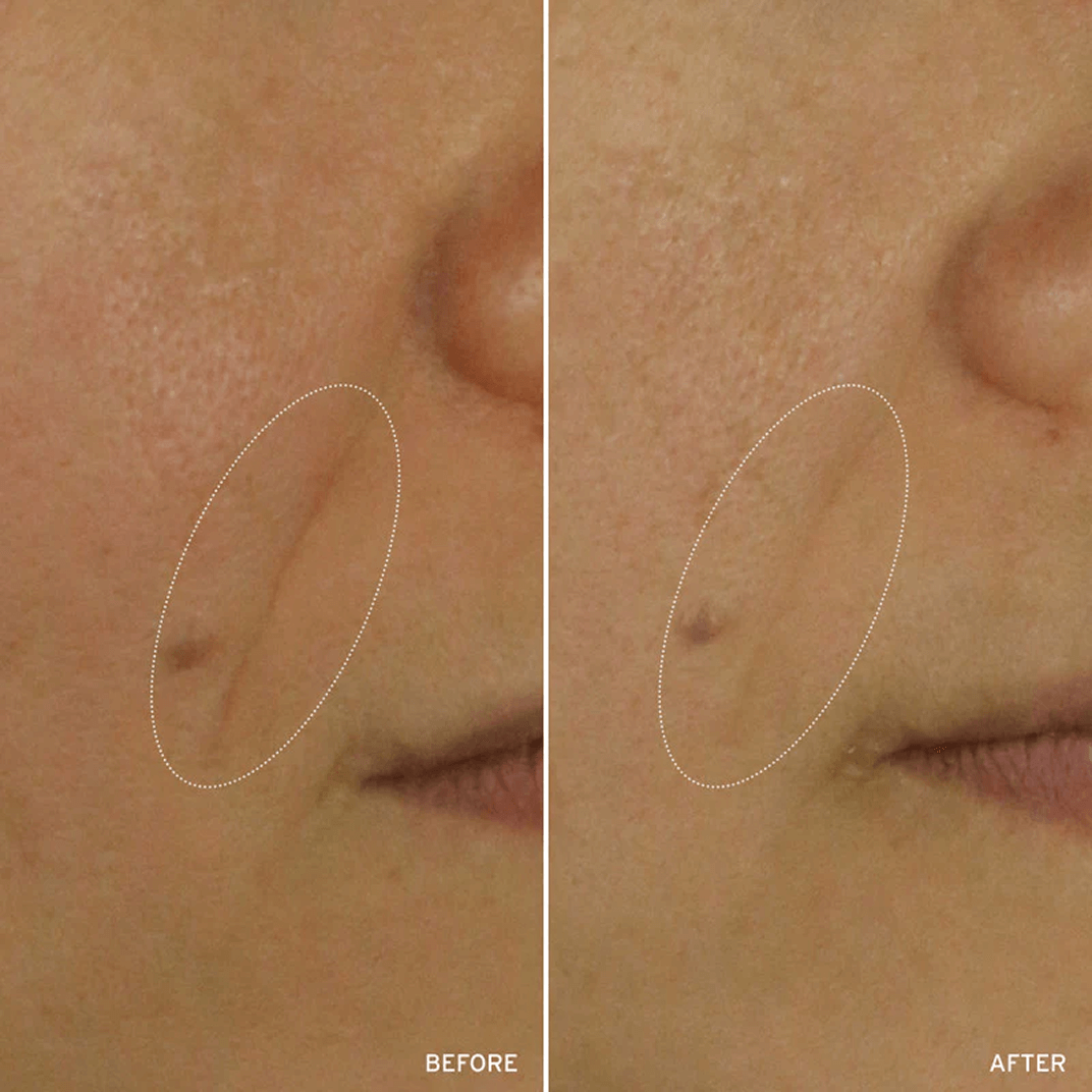 Cell Energizing Treatment before and after comparison highlighting reduction of fine lines and wrinkles on a woman's face