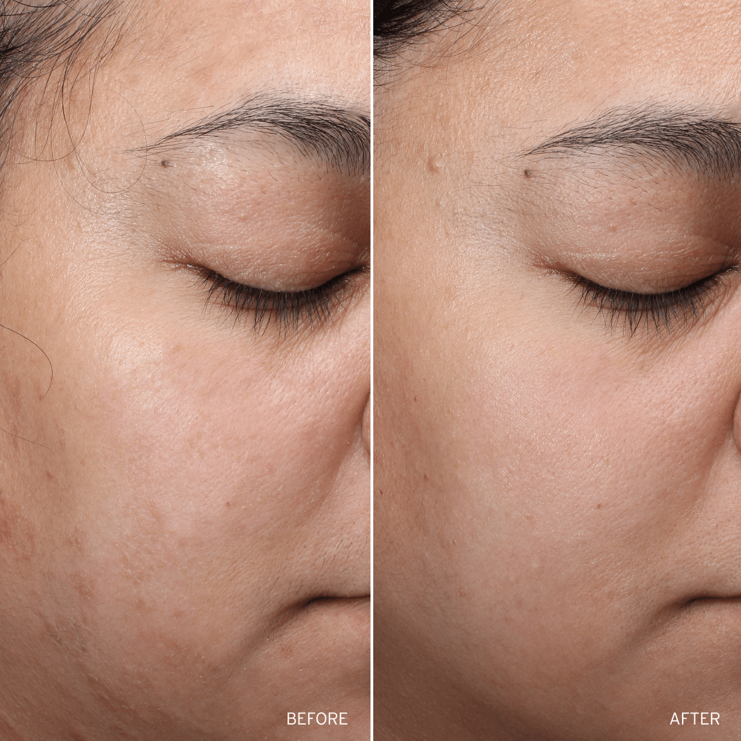Before and after comparison of a woman's eye and cheek area with visible skin texture differences.