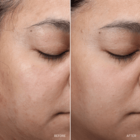 Before and after comparison of a woman's eye and cheek area with visible skin texture differences.