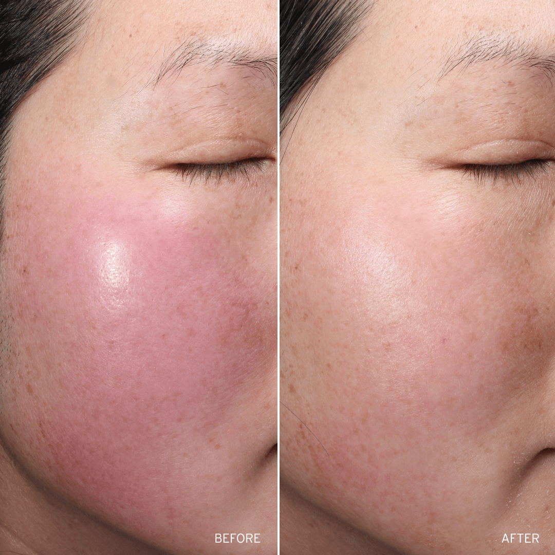 Before and after comparison of a person's face with visible skin texture and redness improvements
