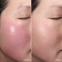 Before and after comparison of a person's face with visible skin texture and redness improvements