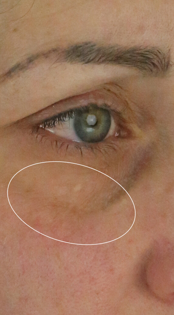 After treatment