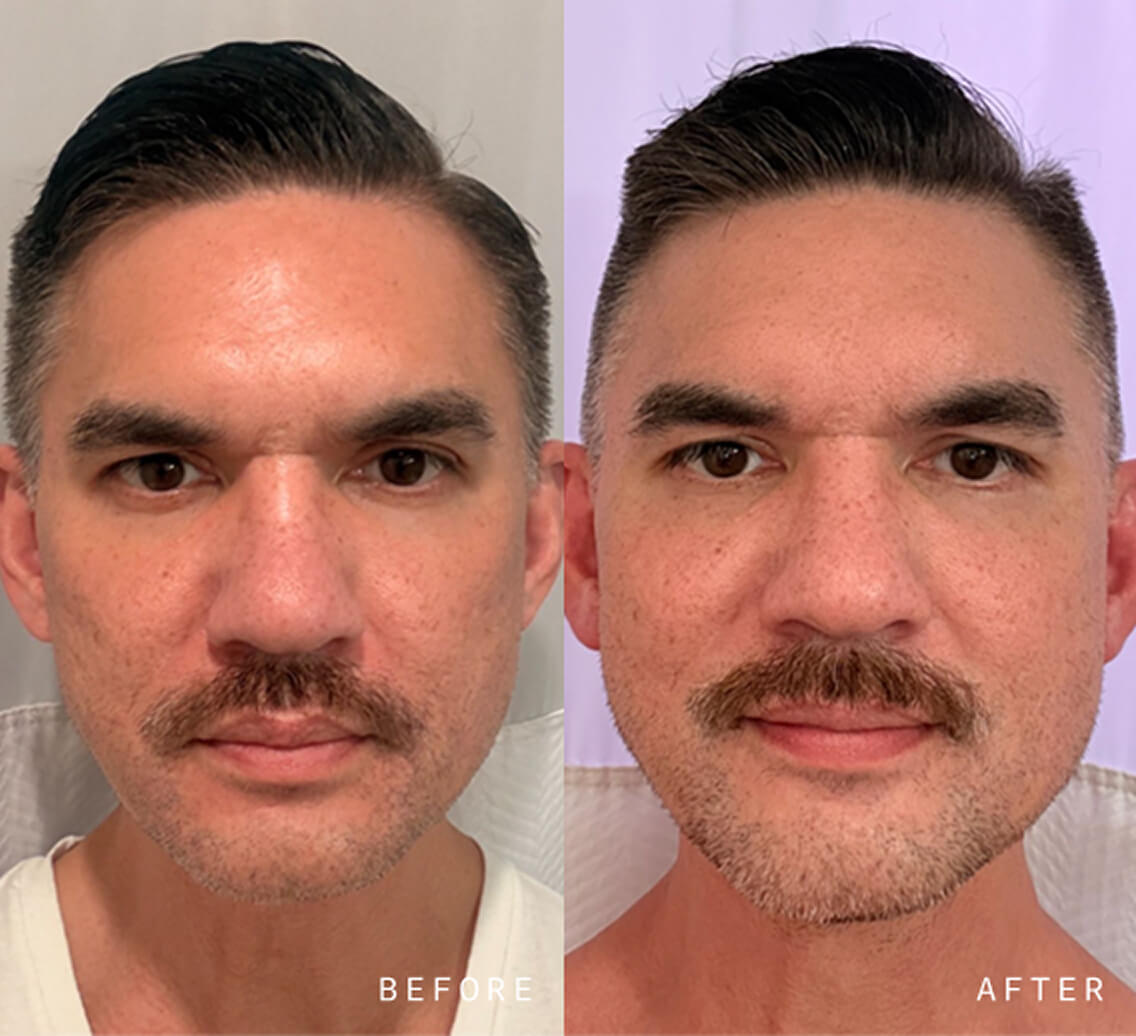 Before and After Results